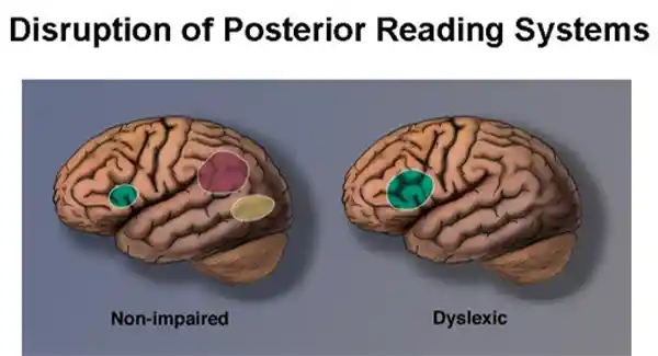 Comparison of a Dyslexic Brain with a non-impaired brain 